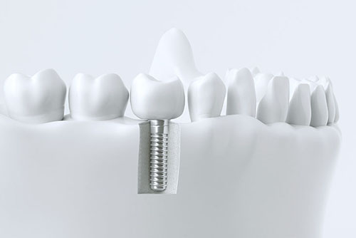 Implantologie - Fachzahnarzt für Oralchirurgie in 52525 Heinsberg